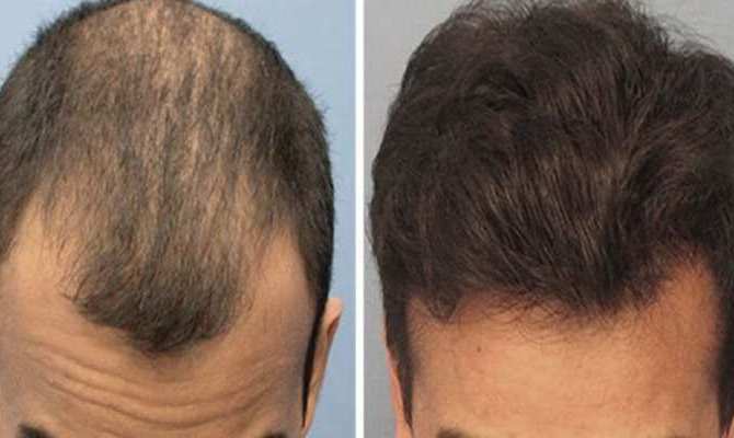 Ganjapan Ka ilaj In Hindi | Hair Problem Treatment in Hindi