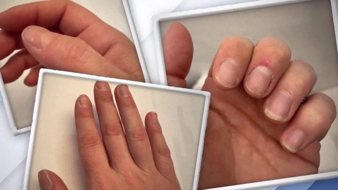 Know your disease from your nail, Nails